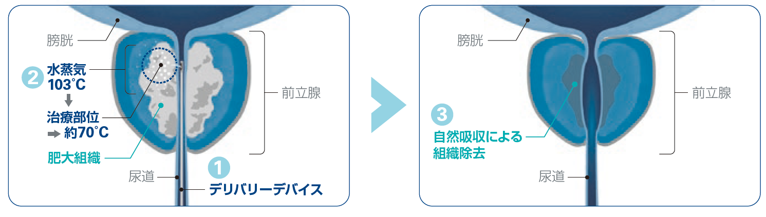 WAVE治療（経尿道的水蒸気治療）