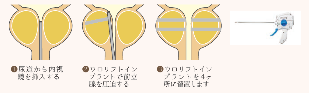 チェック経尿道的前立腺吊り上げ術：UroLiftシステム