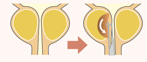 経尿道的前立腺切除術：TUR-P